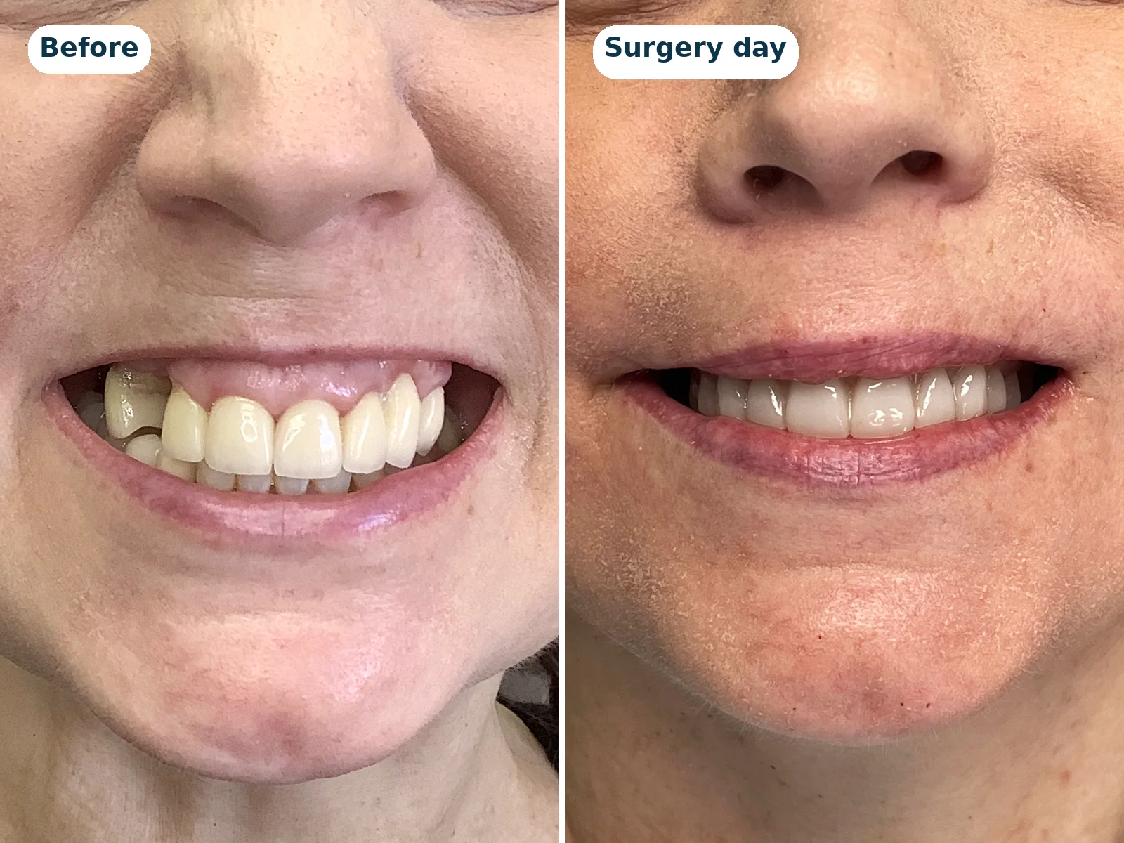 Before and after: an upper All-on-X patient's smile, and the same smile with fixed temporary teeth on surgery day